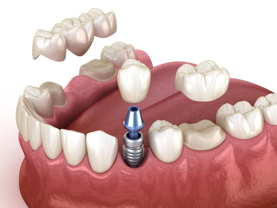 Illustrazione di un impianto con un ponte in ceramica