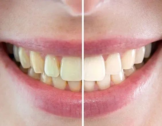 Un sorriso prima e dopo lo sbiancamento, in due metà